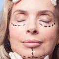 Is cosmetic surgery a qualified medical expense?